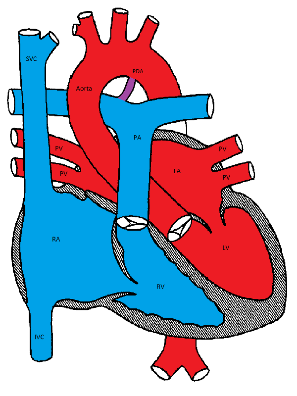 photo ductus arterioisus